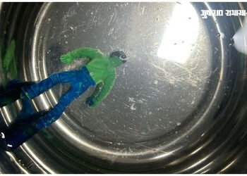 અમદાવાદમાં દોઢ વર્ષનો બાળક આખો ‘હલ્ક’ ગળી ગયો! સિવિલ હોસ્પિટલમાં કરાઇ જટિલ સર્જરી | ahmedabad civil …