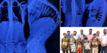 અમદાવાદ સિવિલમાં 7 બાળકોની સાપની જેમ વાંકી વળી ગયેલી કરોડરજ્જુના ઓપરેશન સફળ, નિઃશુલ્ક સર્જરી કરાઈ | …
