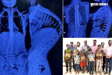 અમદાવાદ સિવિલમાં 7 બાળકોની સાપની જેમ વાંકી વળી ગયેલી કરોડરજ્જુના ઓપરેશન સફળ, નિઃશુલ્ક સર્જરી કરાઈ | …