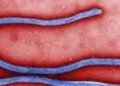 બિઝનેસ ટૂર પર આવેલા યુવકને શંકાસ્પદ ઇબોલા | Suspected Ebola in young man on business trip