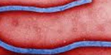 બિઝનેસ ટૂર પર આવેલા યુવકને શંકાસ્પદ ઇબોલા | Suspected Ebola in young man on business trip